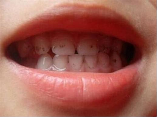 小孩牙齒發黑是怎么回事