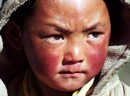 為什么會出現高原紅？