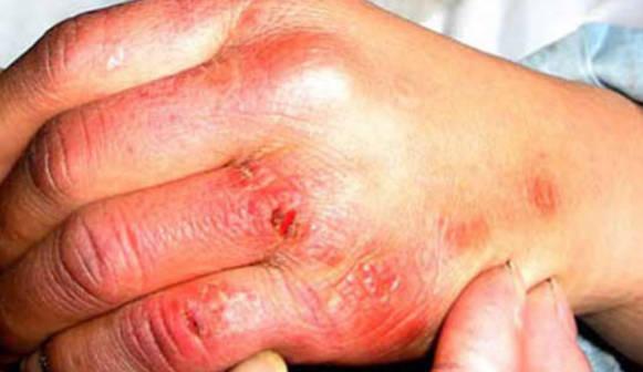 冬天患凍瘡很痛苦，如何能徹底根治？