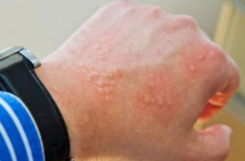 怎么能快速止癢？