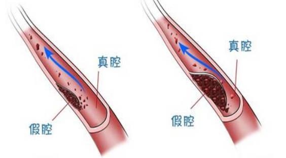 血管夾層是什么病？