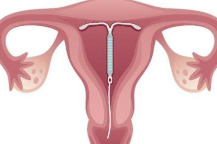 女性上環對身體健康有哪些影響？