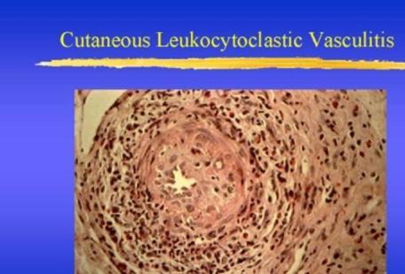 系統(tǒng)性血管炎多久能治好