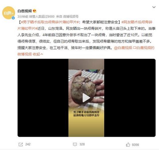 山東菏澤男子手術(shù)取出顱骨碎片，提醒注意安全佩戴護(hù)具