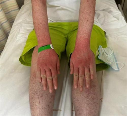 杭州女子吳霞中恙蟲病，全身紅斑如火龍果，20元倉鼠引發(fā)傳染風(fēng)險！