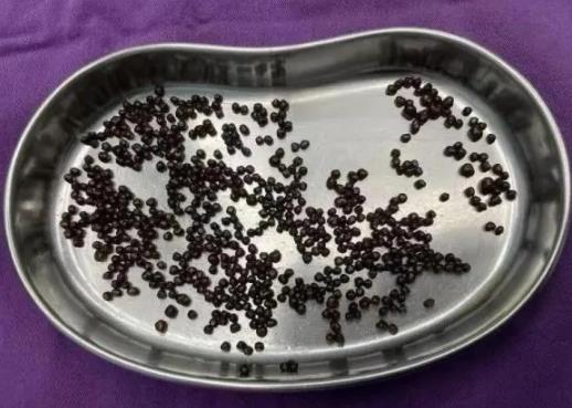 誤診為胃病！66歲王阿姨腹痛腹脹半年，最終發現膽囊結石