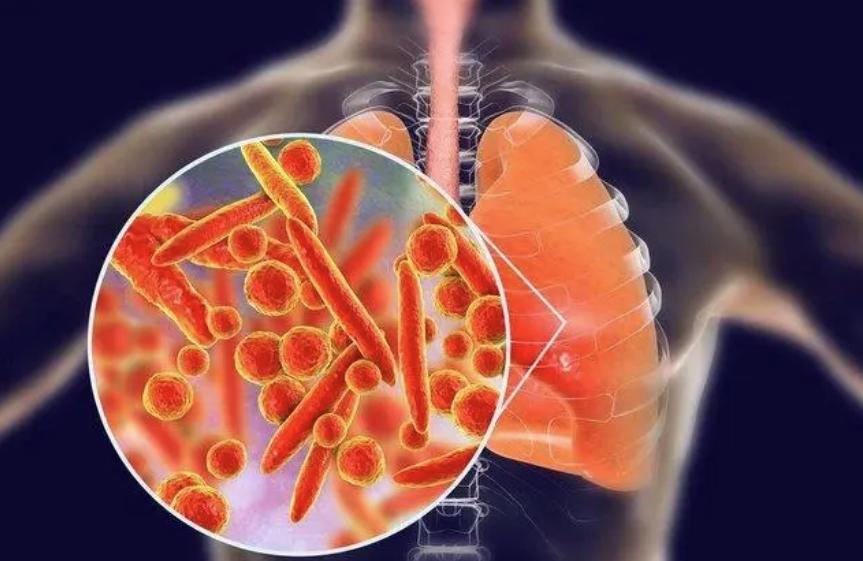 肺炎支原體感染：兒科醫生解讀是否迎來高峰期